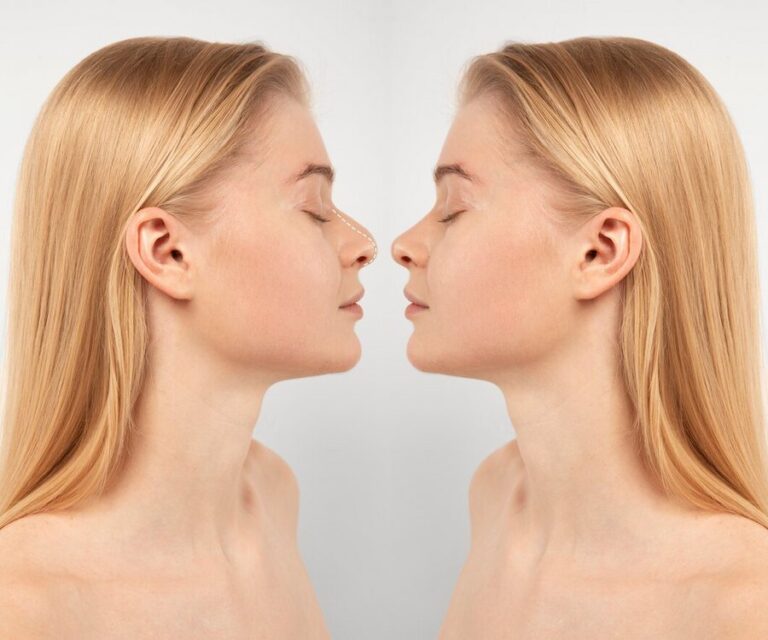 En la foto se muestra una comparativa entre el antes y el después de una rinoplastia, (una operación estética para perfilar la nariz) en una chica joven y rubia