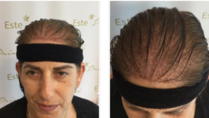 Formación especializada en salud capilar