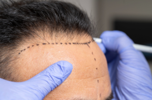 Quién puede someterse a una cirugía capilar femenina