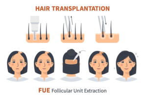 Técnica FUE (Extracción de Unidades Foliculares)