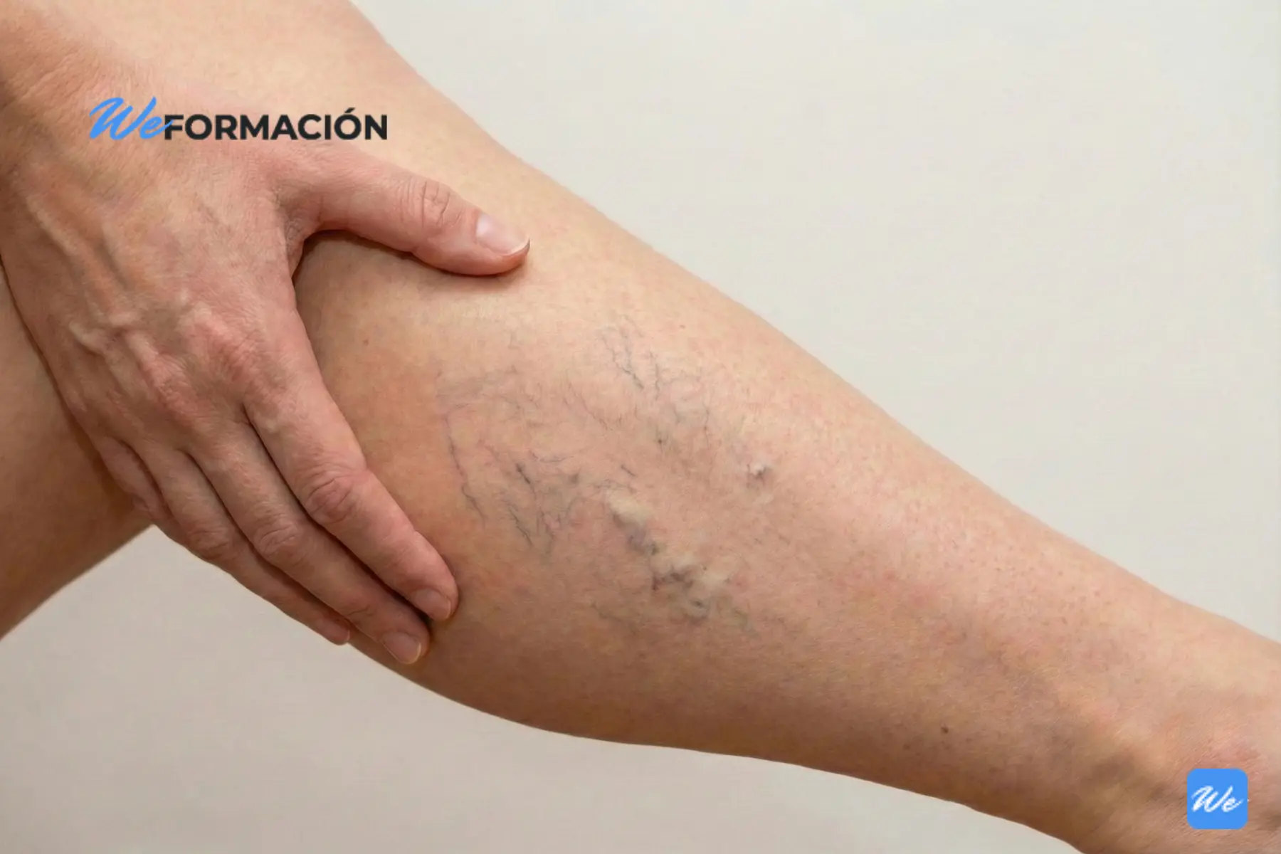 Qué es la flebología en medicina estética