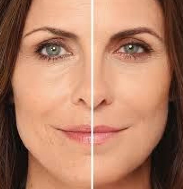 Materiales de relleno en medicina estética: guía completa para auxiliares y profesionales de clínicas estéticas 2 hidroxiapatita calcica antes despues piel - Materiales de relleno en medicina estética: guía completa para auxiliares y profesionales de clínicas estéticas 2026