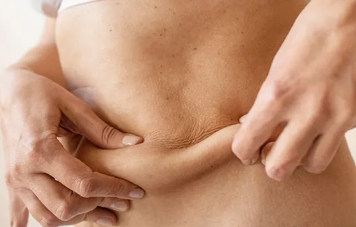Adiposidad localizada: qué es, tipos, causas y clasificación 1 Manos pellizcando un pliegue de grasa localizada en el abdomen