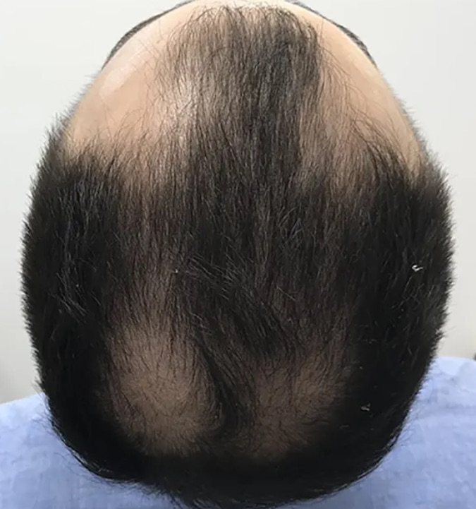 Alopecias más frecuentes en medicina estética: androgenética, areata, efluvio telógeno y otras patologías del cuero cabelludo 1 Vista superior del cuero cabelludo de un hombre con alopecia androgenética en la coronilla