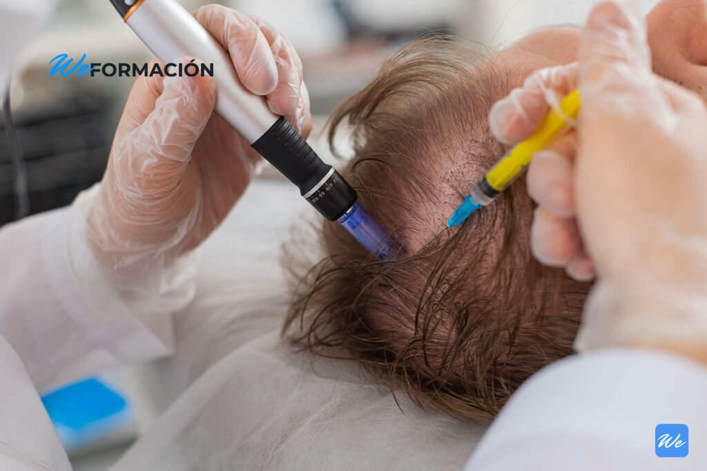 Infiltración de un tratamiento capilar en el cuero cabelludo de un paciente con alopecia