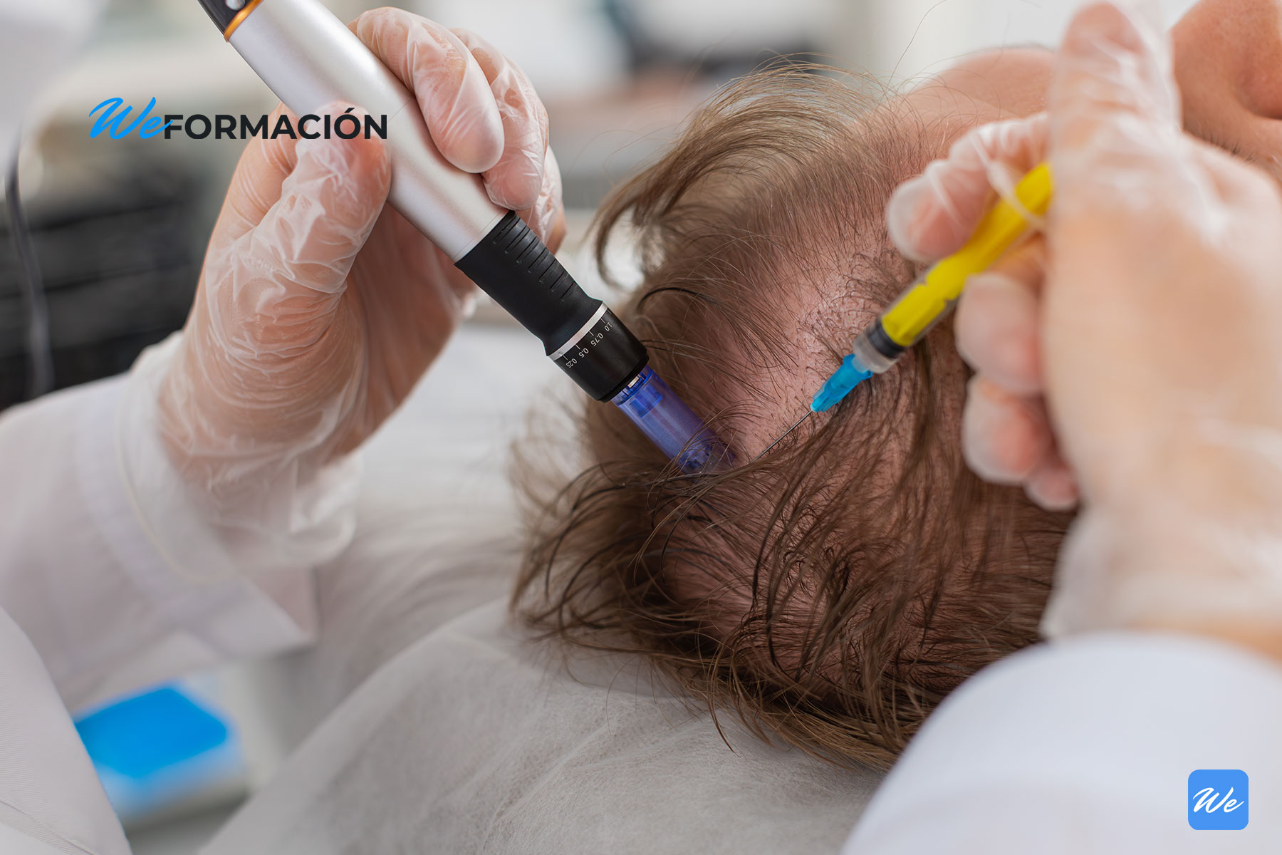 Infiltración de un tratamiento capilar en el cuero cabelludo de un paciente con alopecia