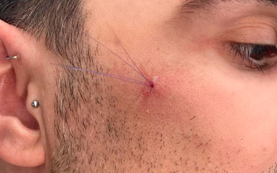 Hilos tensores en medicina estética: qué son, cómo funcionan y cuál es el papel del auxiliar 1 Hilos tensores insertados en la zona lateral del rostro de un paciente
