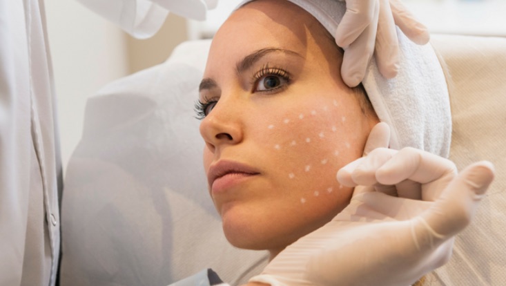 Mesoterapia en medicina estética: qué es, cómo funciona, productos y protocolo del auxiliar 1 Micropápulas en la mejilla de una paciente tras una sesión de mesoterapia facial