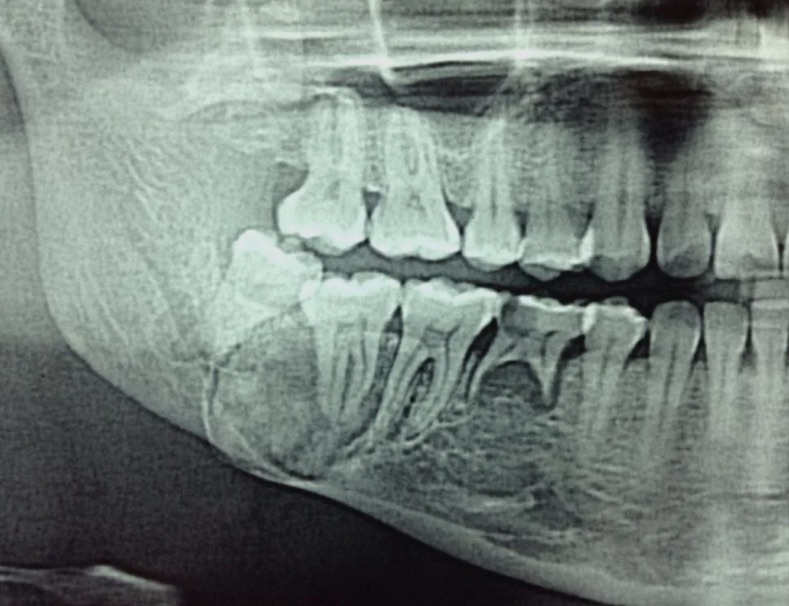 Introducción a la Odontología: historia, especialidades y conceptos fundamentales 1 Radiografía panorámica que muestra las arcadas dentarias superior e inferior