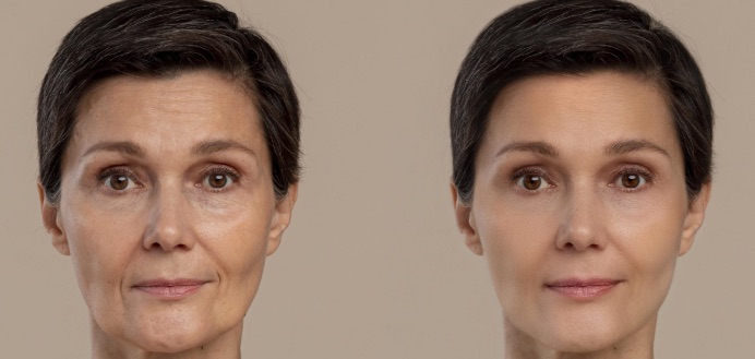 Facial contouring: anatomía, técnicas y límites de la remodelación facial 1 Comparación del rostro de una mujer madura antes y después de un tratamiento de remodelación facial